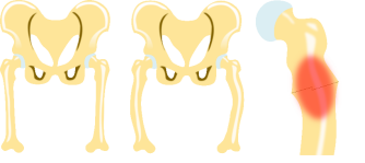 Osteomalazie