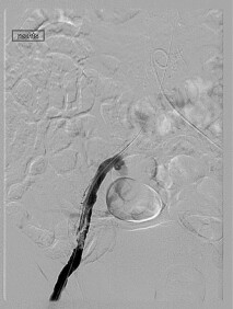 Dissektion der Beckenarterie